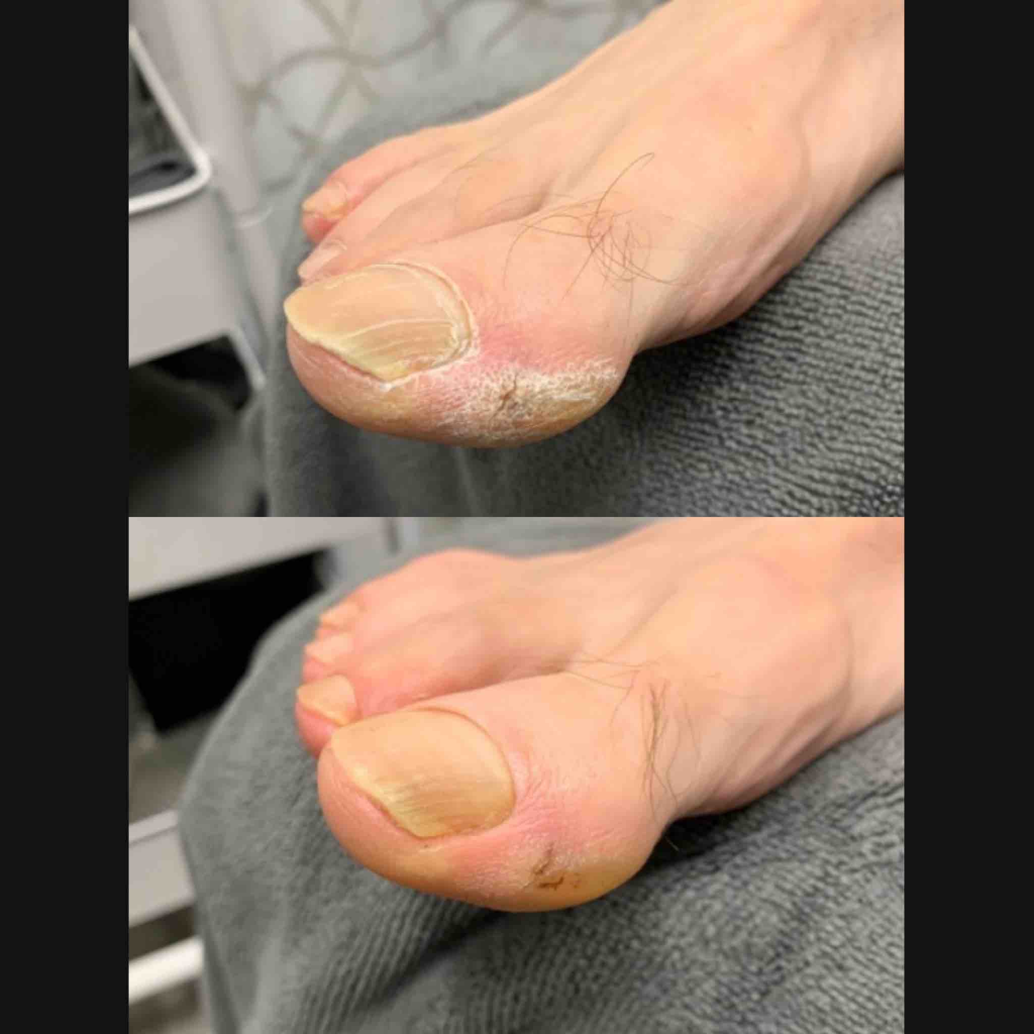 Callus Pedicure