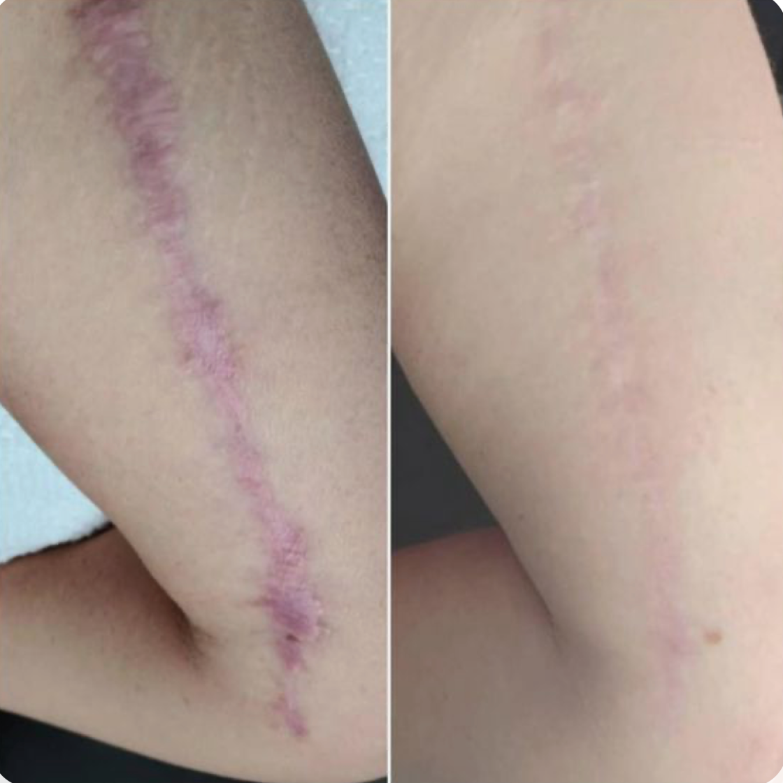 Barely-There Scar Renewal
