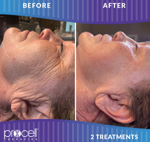 PROCELL THERAPIES FACIAL