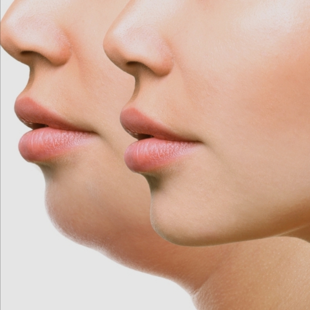 Face Tightening & Double chin (3 Sessions) at Le Bar Beaute in Indian Trail, NC