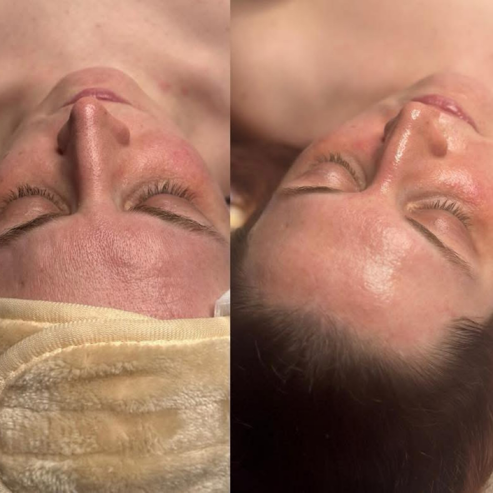 The Chemical Peel at beYOUtiful Esthetic & Bridal in Winnebago, IL