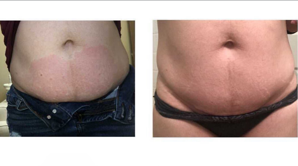 Fat Dissolve (4 Sessions)