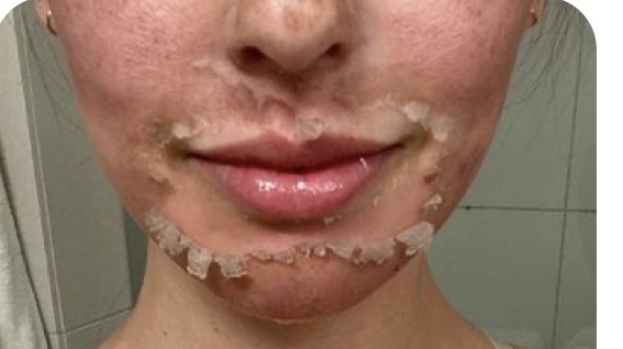 Chemical Peel