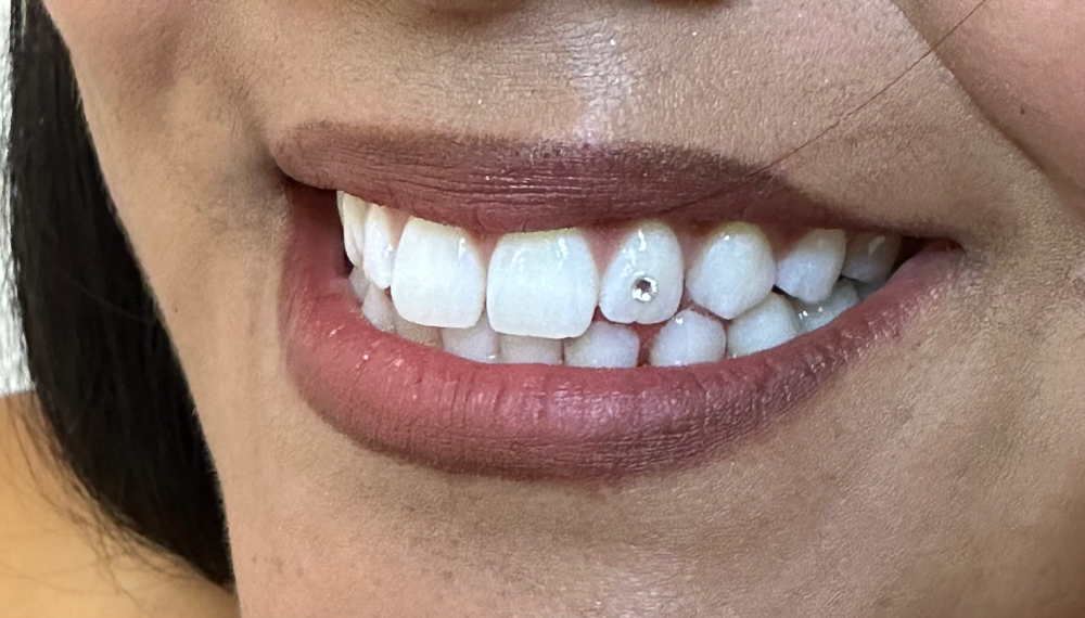Crystal Tooth Gem
