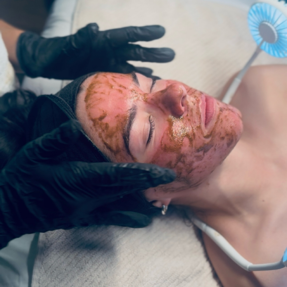 Liquid Microneedling at Native Complexions in Winchester, KY