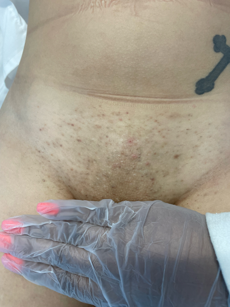 Full Brazilian Wax