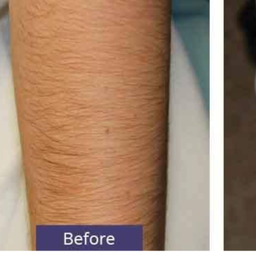 Full Arms Laser Hair Removal at The Beautee Spot in Phoenix, AZ