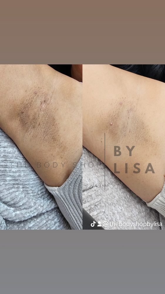 Underarm Color Correction