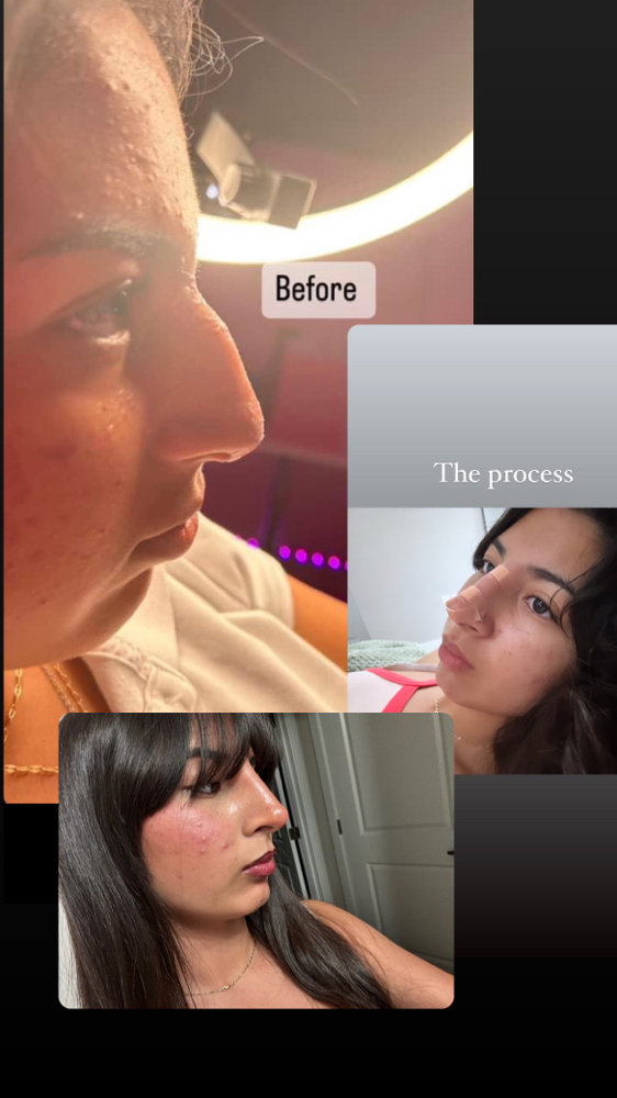 Nose Fillers 1.5 Ml