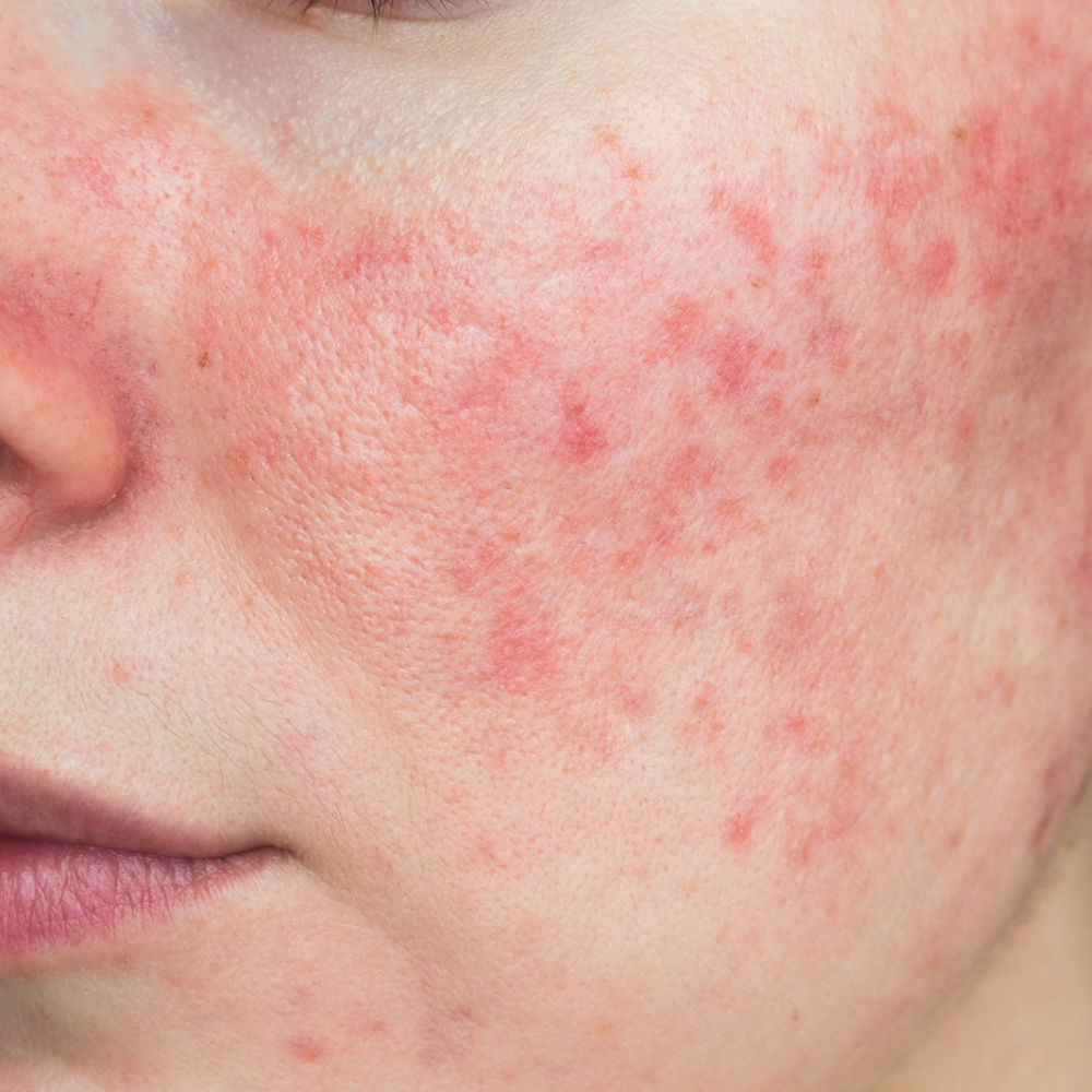 ROSACEA FACIAL