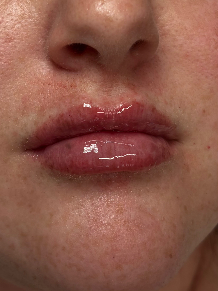Mini Lip Half Syringe at Eluxy Aesthetics in Arlington, TX