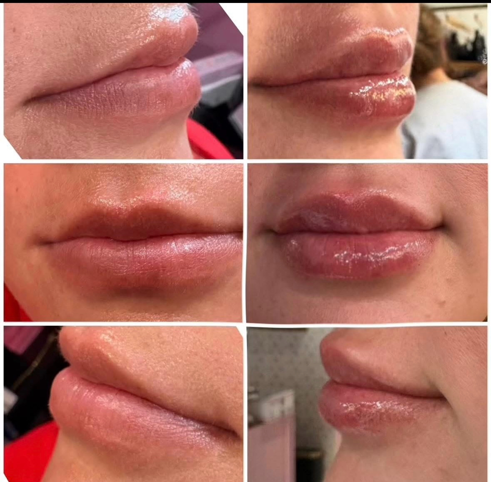 Lip filler (Full Syringe $550)