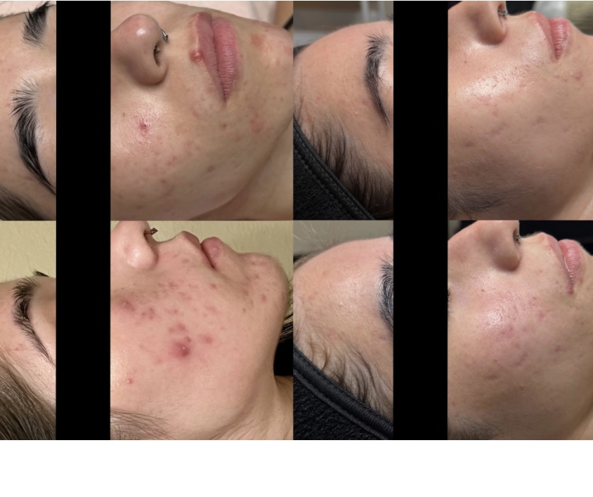CLEAR MY ACNE FACIAL
