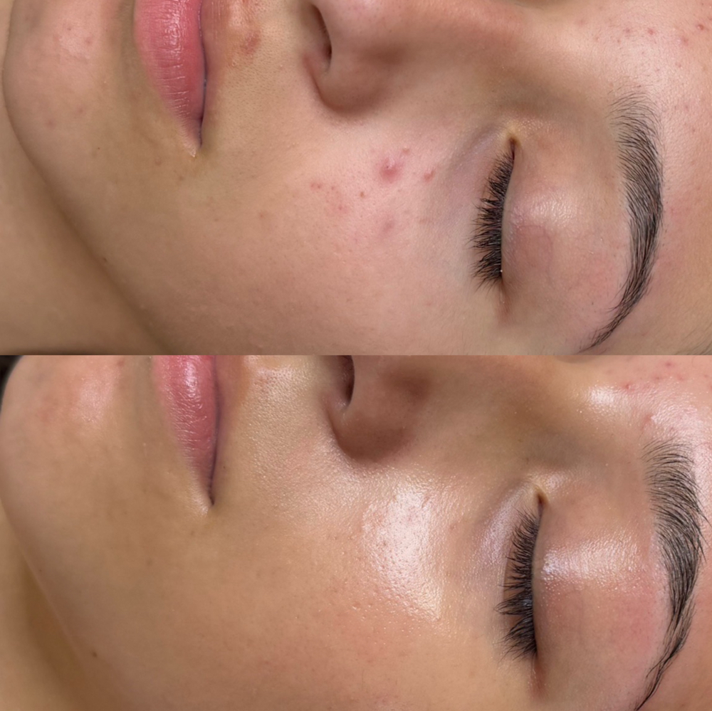 CLEAR MY ACNE FACIAL
