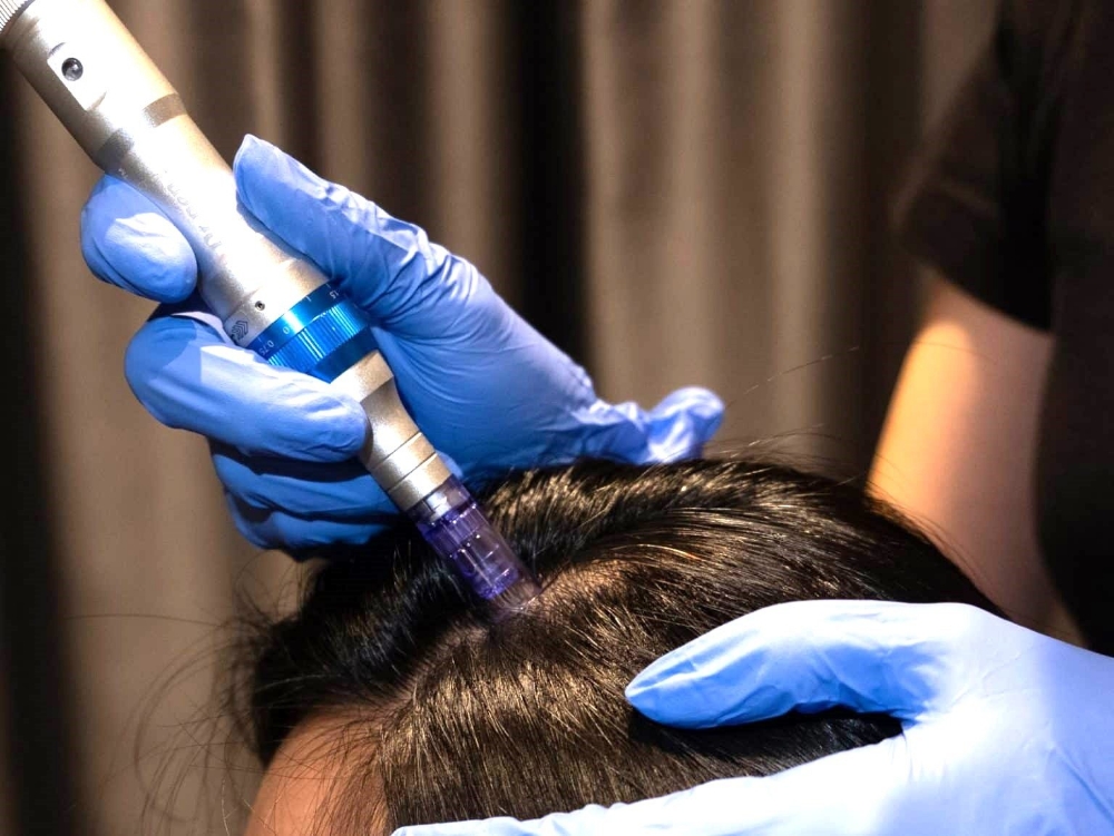 Scalp Microneedling