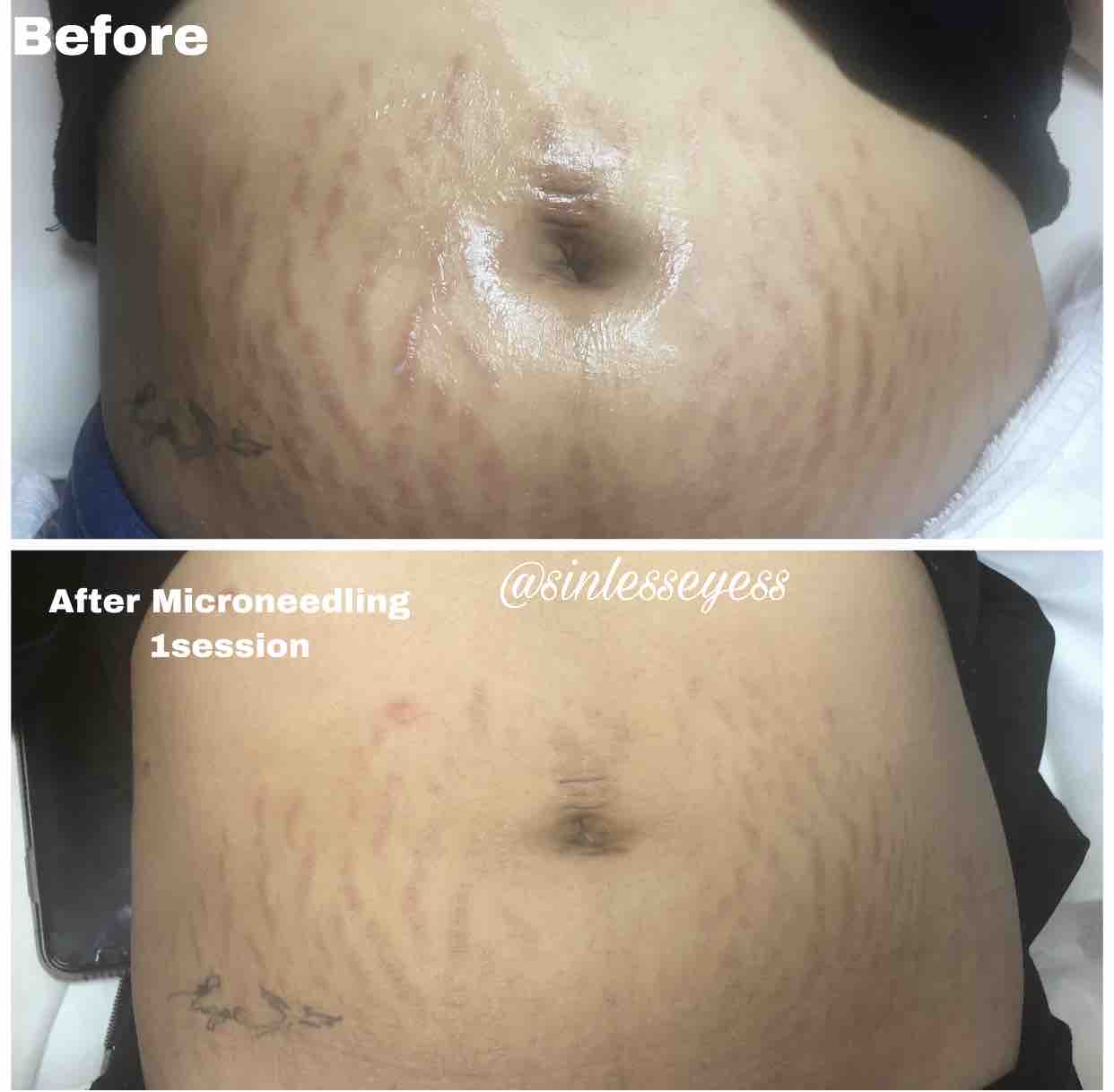 Microneedling Stretch Marks/ Scars