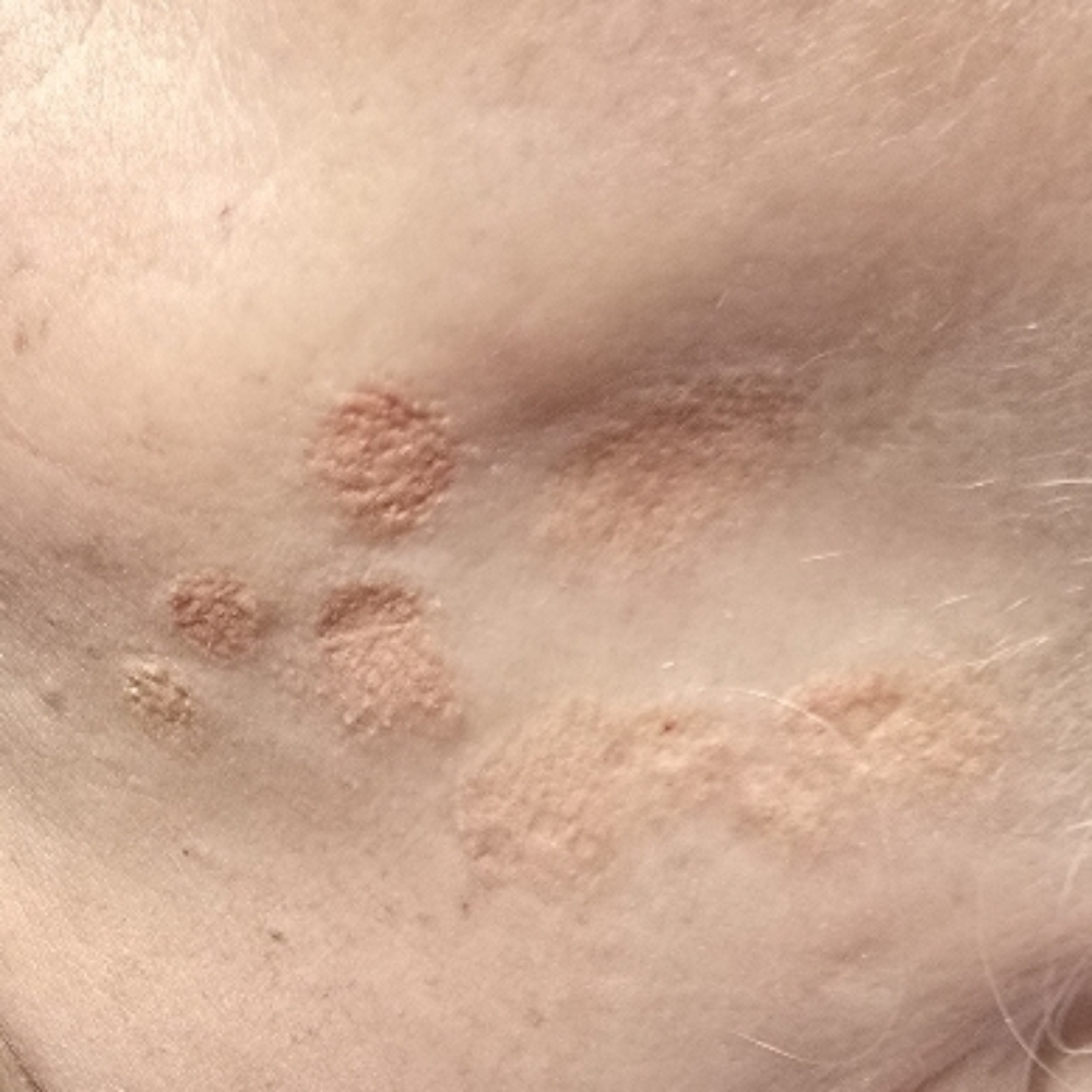 Scar Revision & Camouflage at Carole's Cosmetic Tattoo in Beaverton, OR