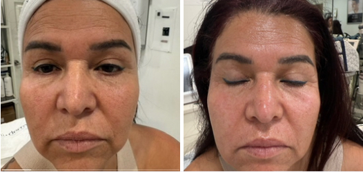 Micro-needling