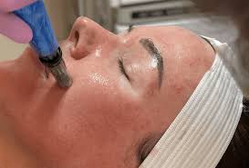 Microneedling