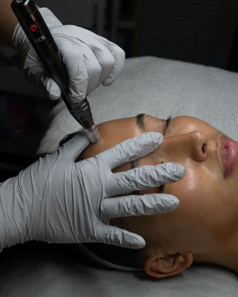 Nanoinfusion Facial
