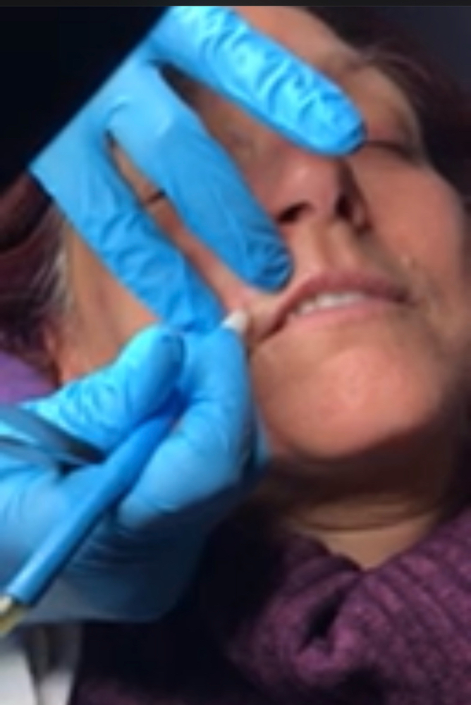Electrolysis Hair Removal