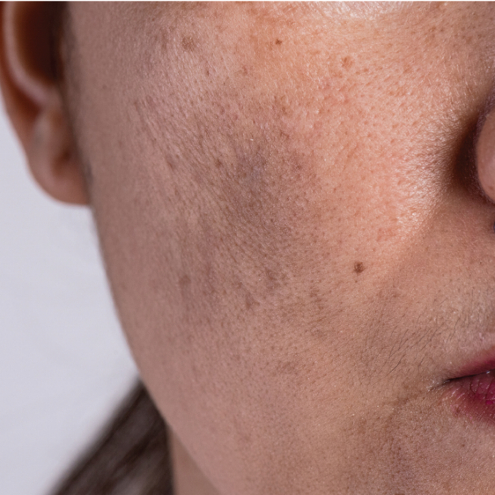 Pigmentation Correction Peel at LUNA Beauty Lounge in Destin, FL