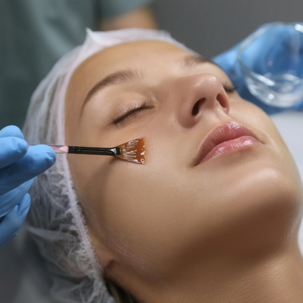 Chemical Peel