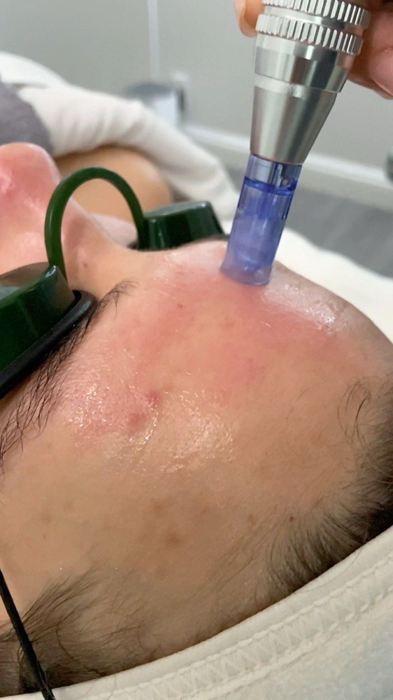 Paquete de Microagujas (4 Sesiones) at Skin Garden Studio in San Juan, PR
