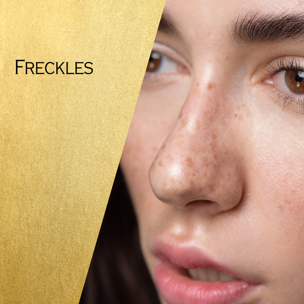 Freckles