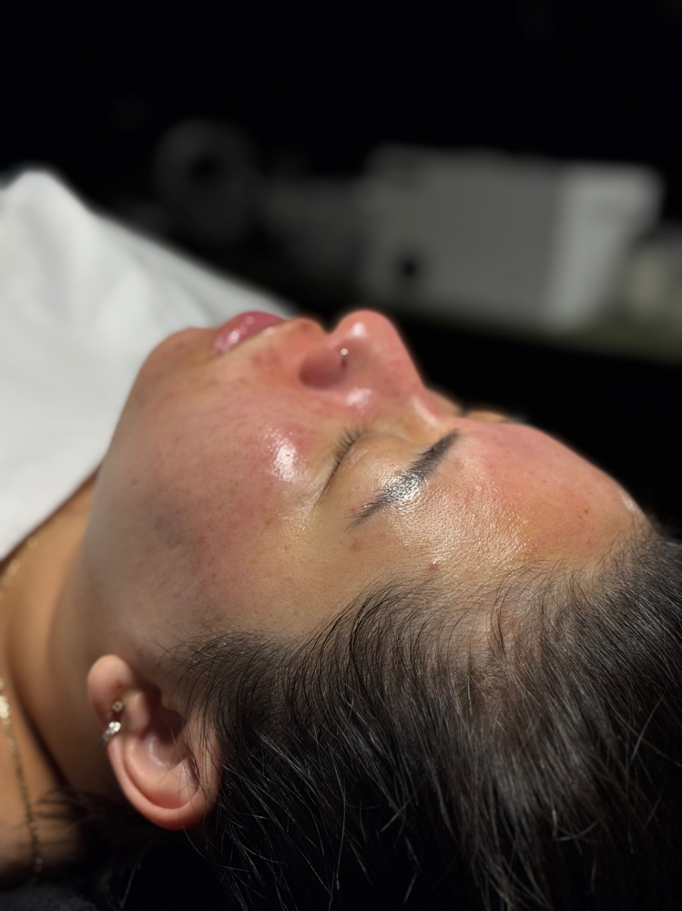 Signature Chemical Peel at Fidelis Skin Theory in Las Vegas, NV