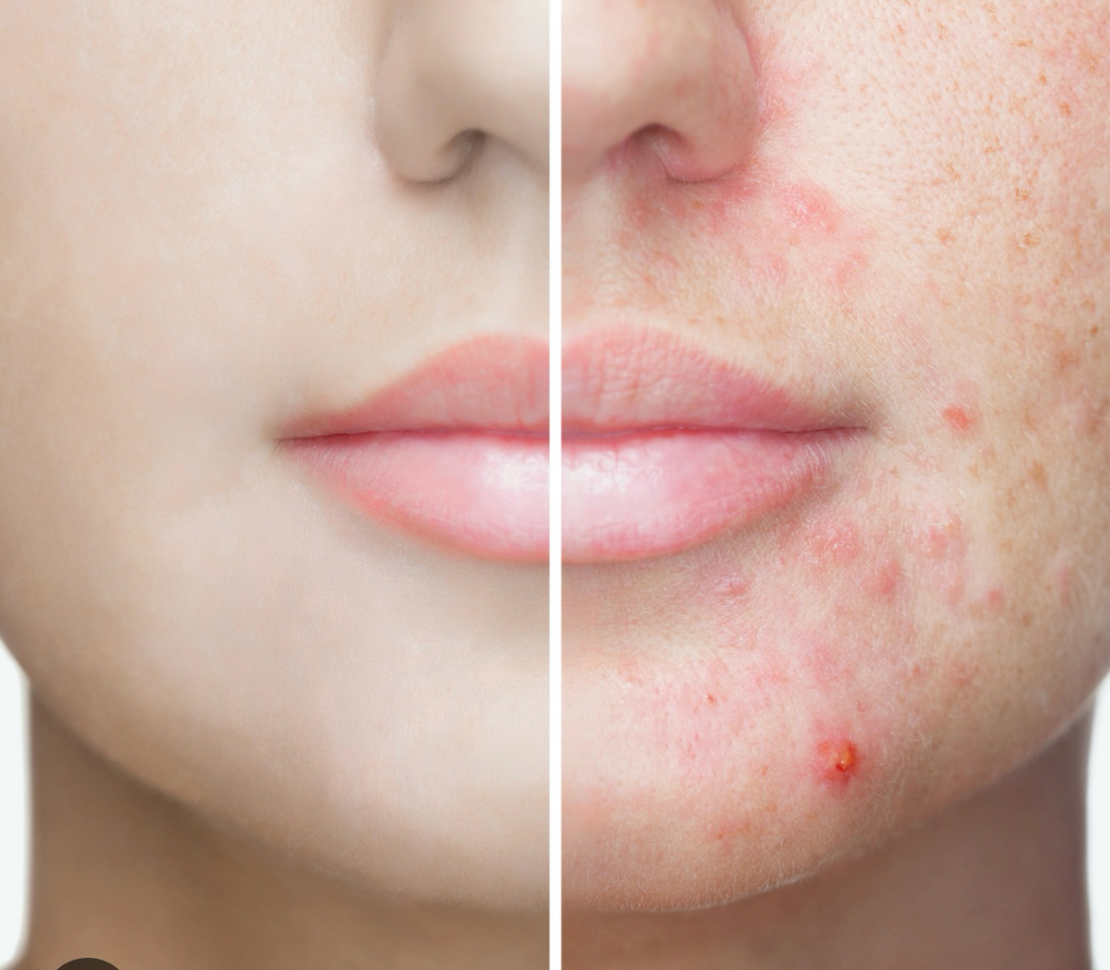 Customized Acne Treatment