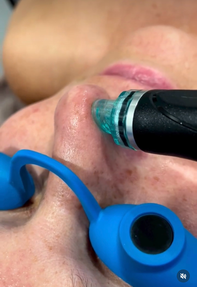 Signature Hydrafacial