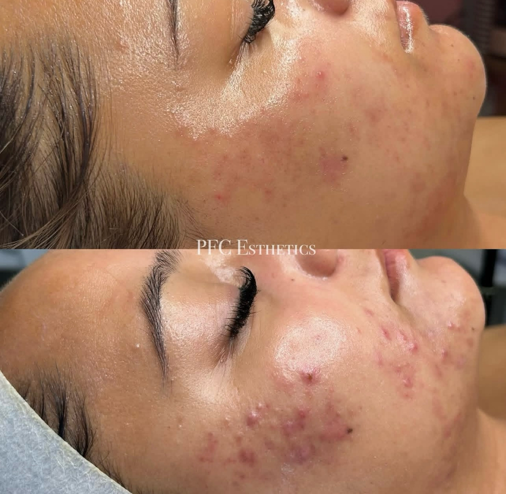 Custom Acne Facial