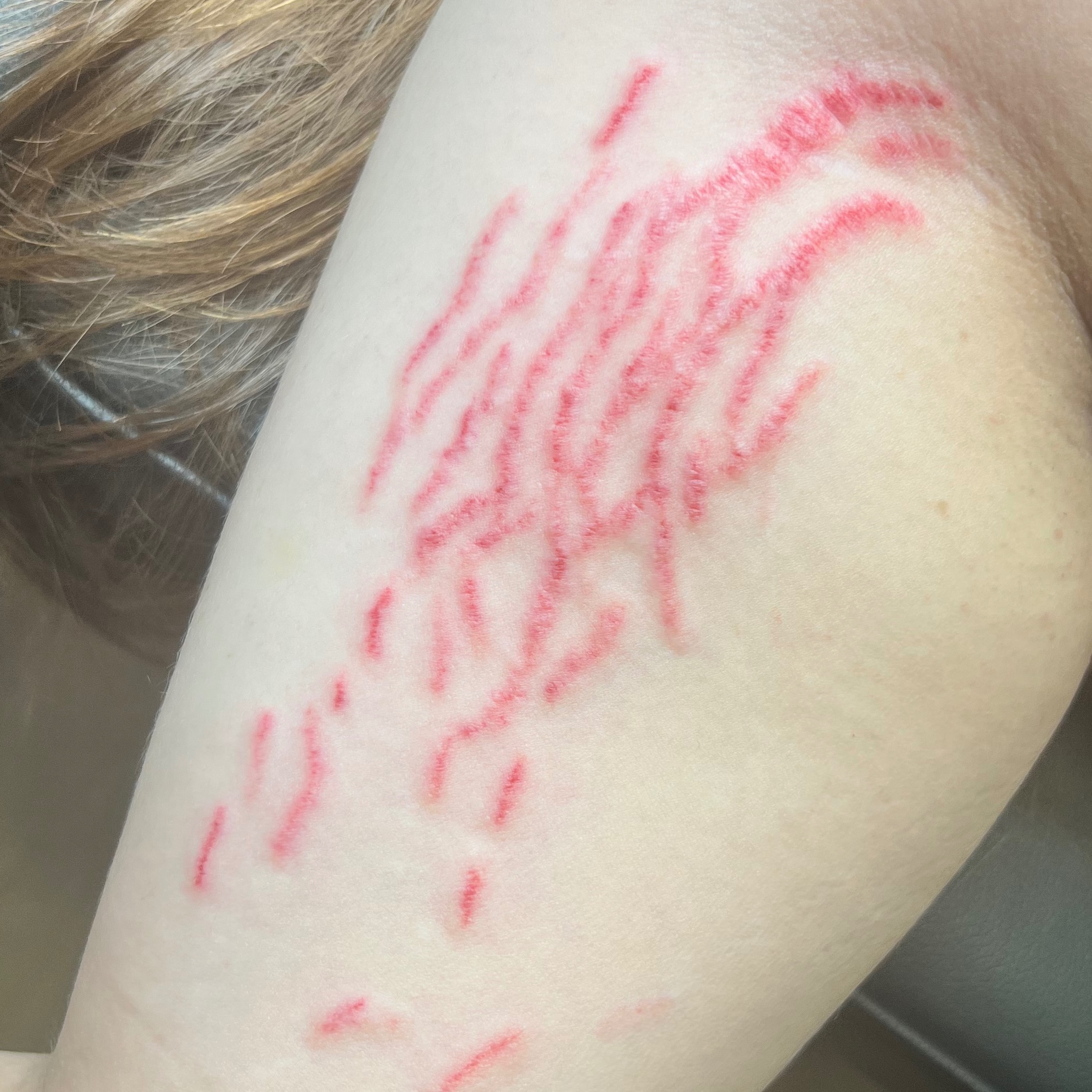 Scar/Stretch Mark Camouflage Inkles at Permanent Cosmetics By Alicia Polk in Bentonville, AR