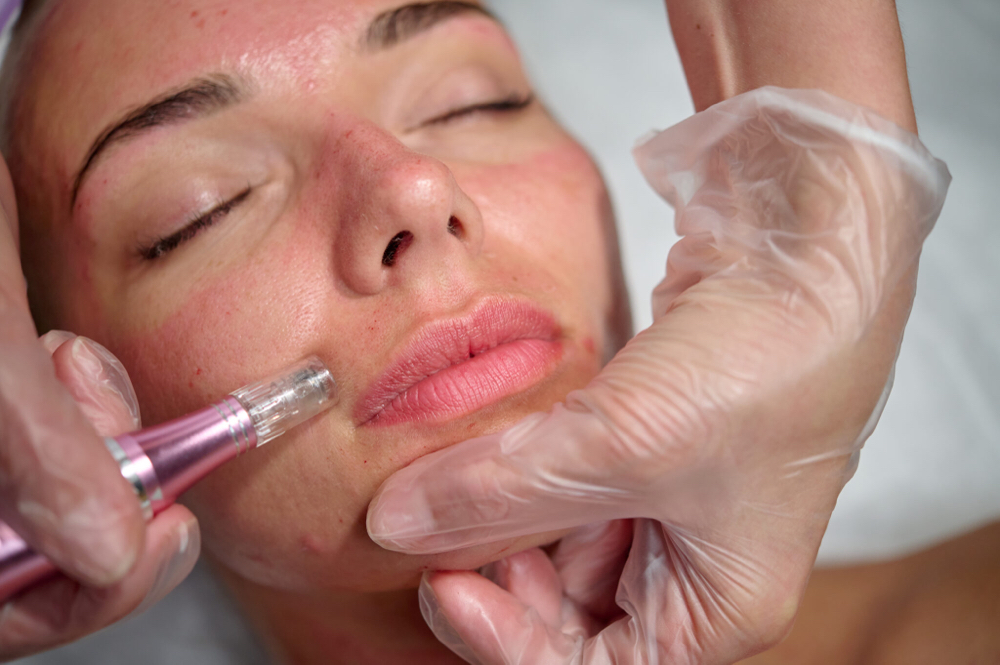 Microneedling Facial
