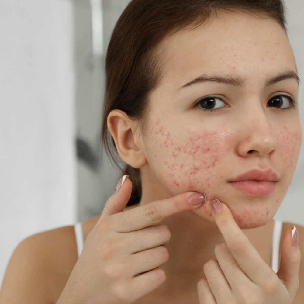 Back-to-School Acne Glo Facial at Melaglo Skin in Coral Springs, FL