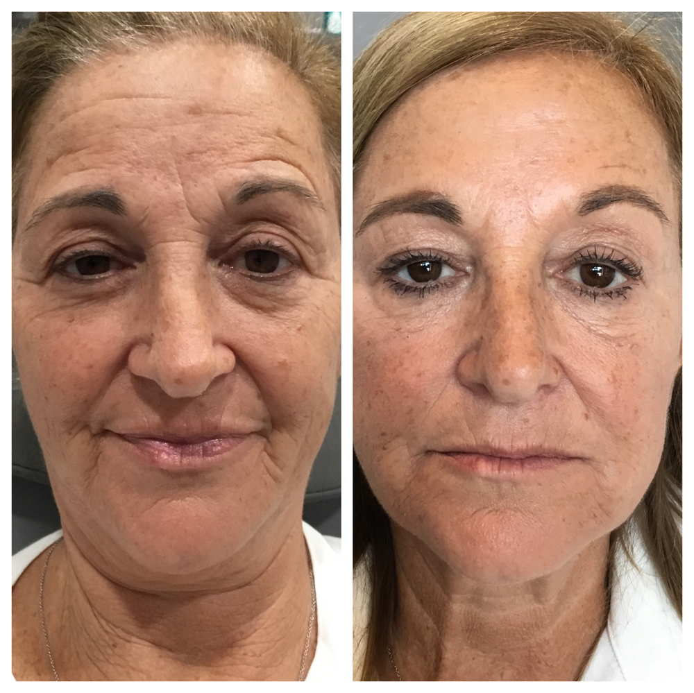 Daxxify/Dysport/Xeomin/Botox at Aesthetic NP Marie in Portland, OR