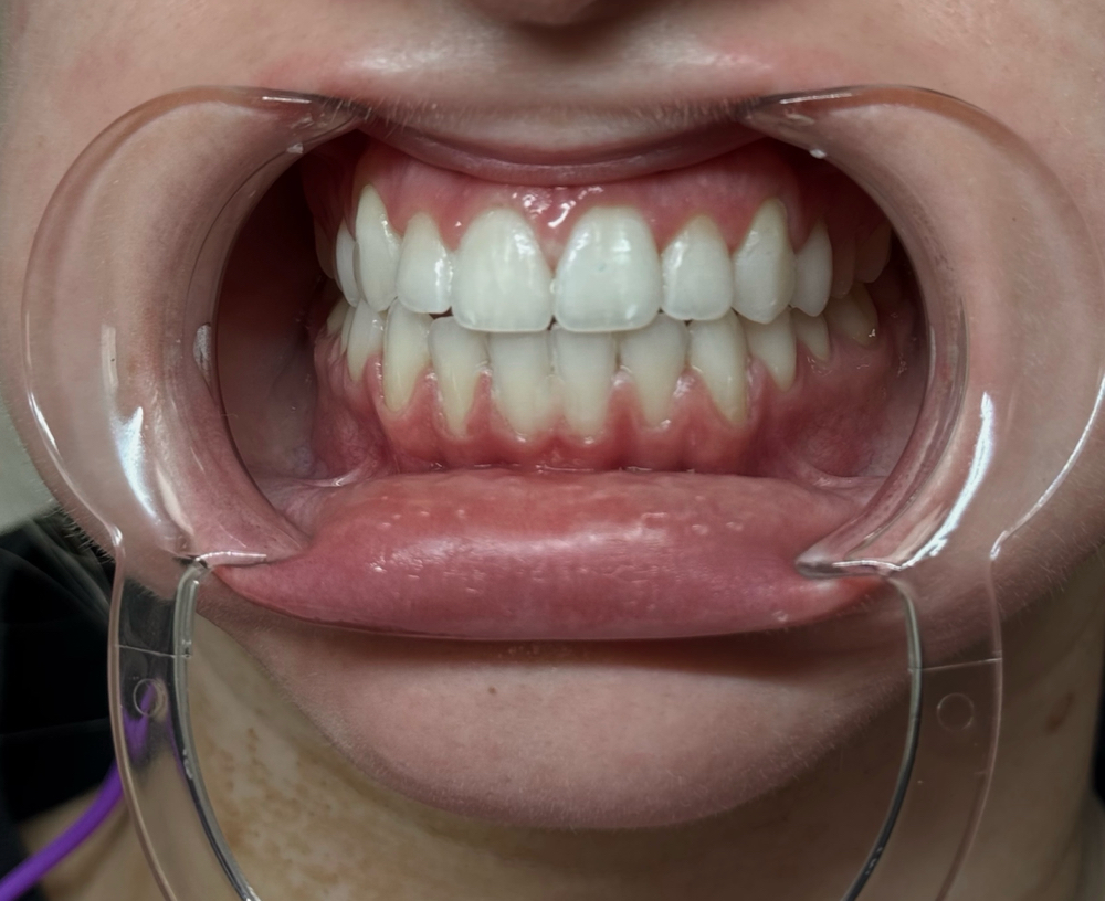30 Min Express Whitening Session