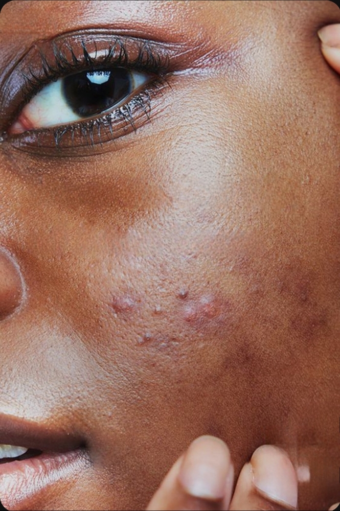 Acneic Skin