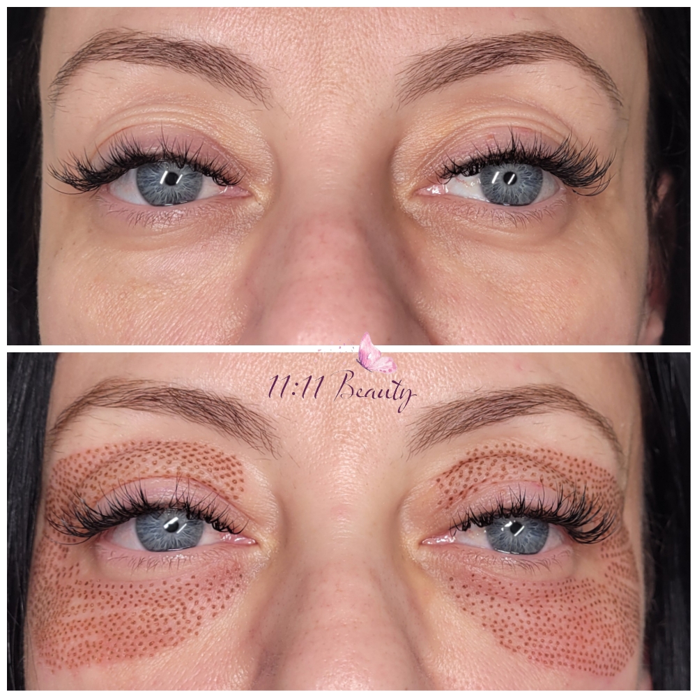 Fibroblast Around The Eyes