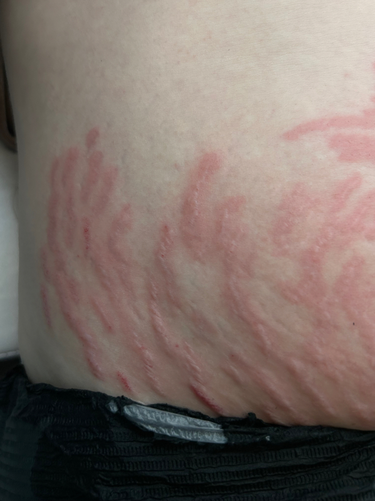 Stretch mark revision
