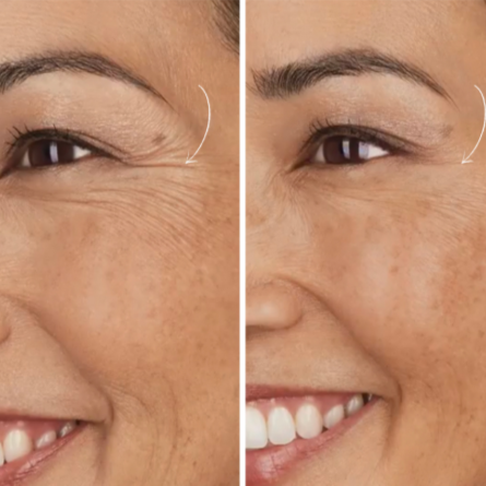 ADD ON: brow lift or crows feet at Chelsea Injects in Kingwood, TX