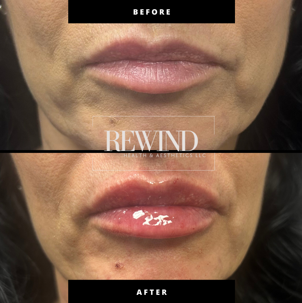 Mini Lip Plump at Rewind Health & Aesthetics LLC in San Marcos, TX