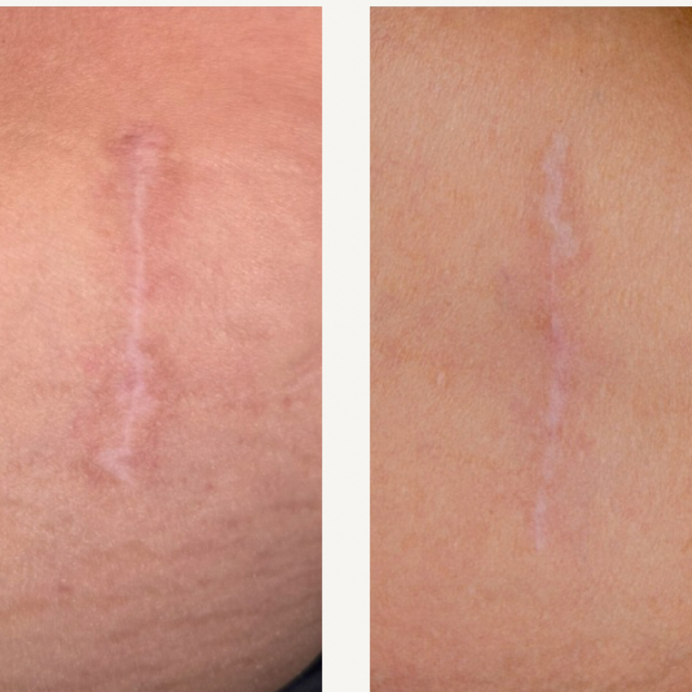 Scar Camoflauge at Reese SkinTreat in Cape Girardeau, MO