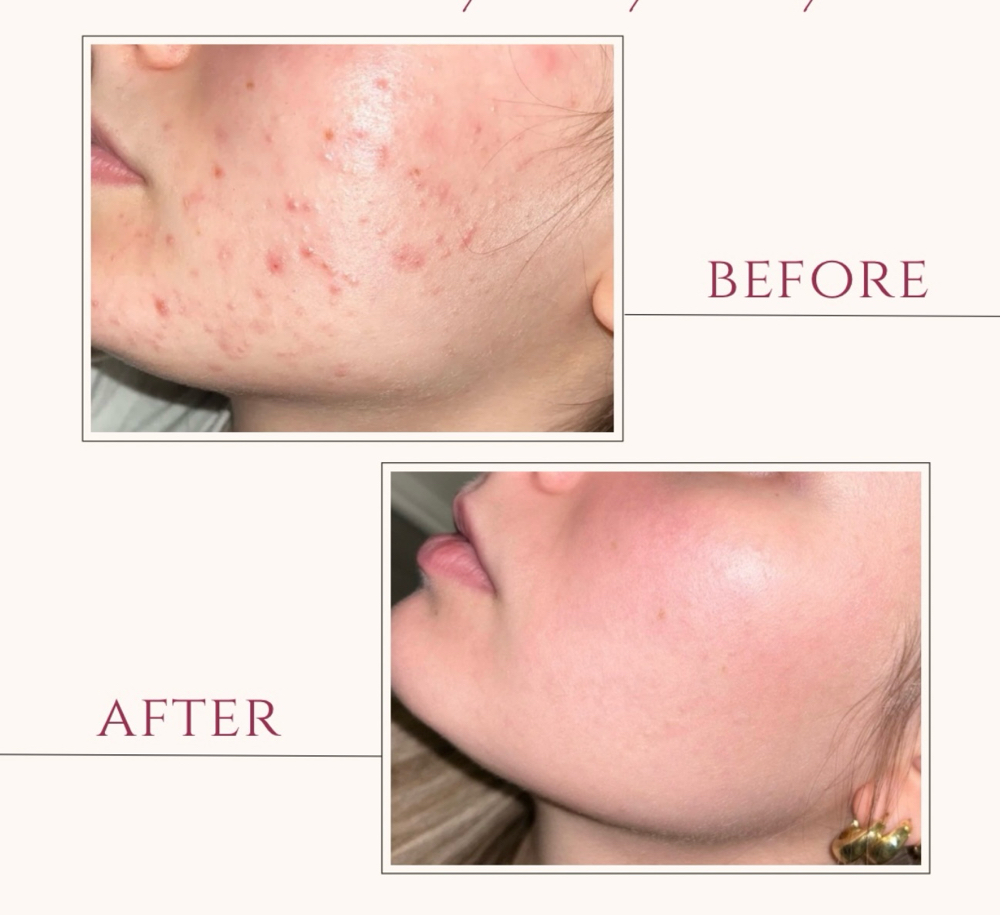 Chemical Peel Treatment