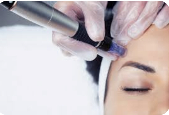 Face Microneedling W/Peel