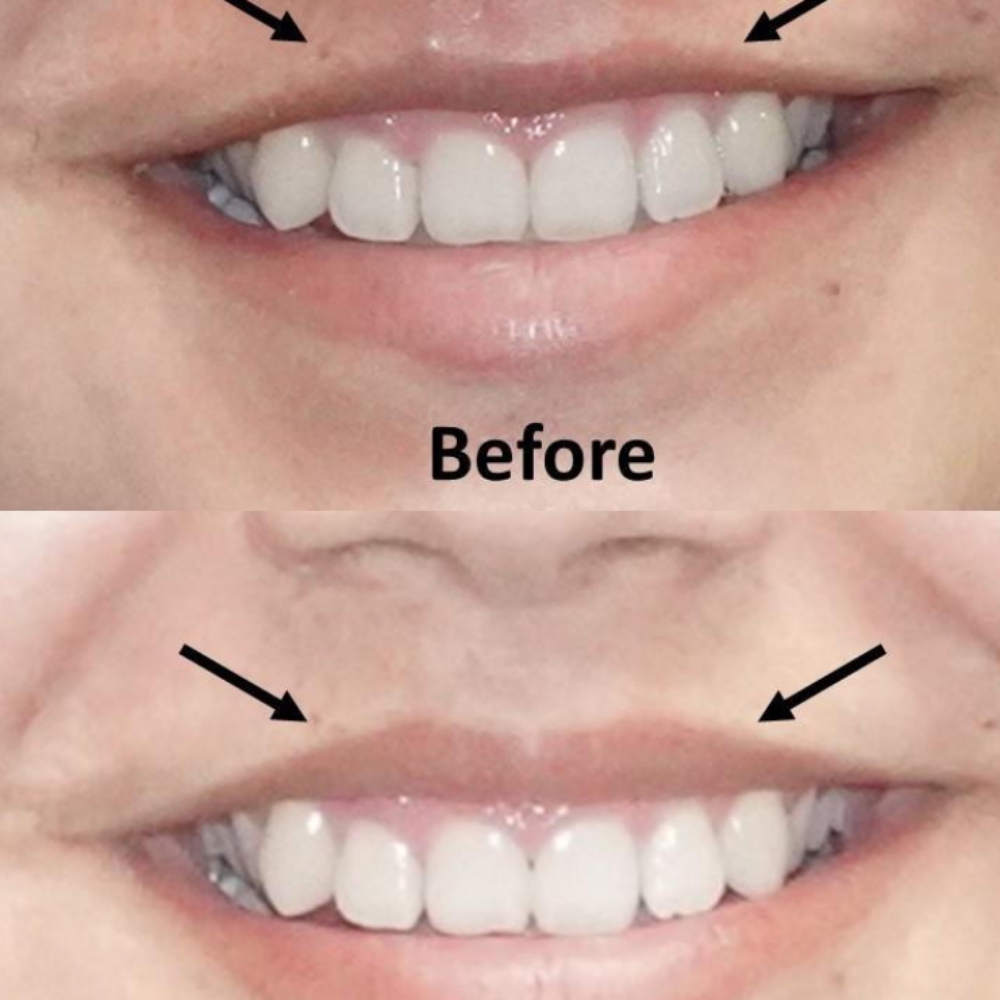 Lip Flip at Ultimate Health Spa in Leesburg, FL
