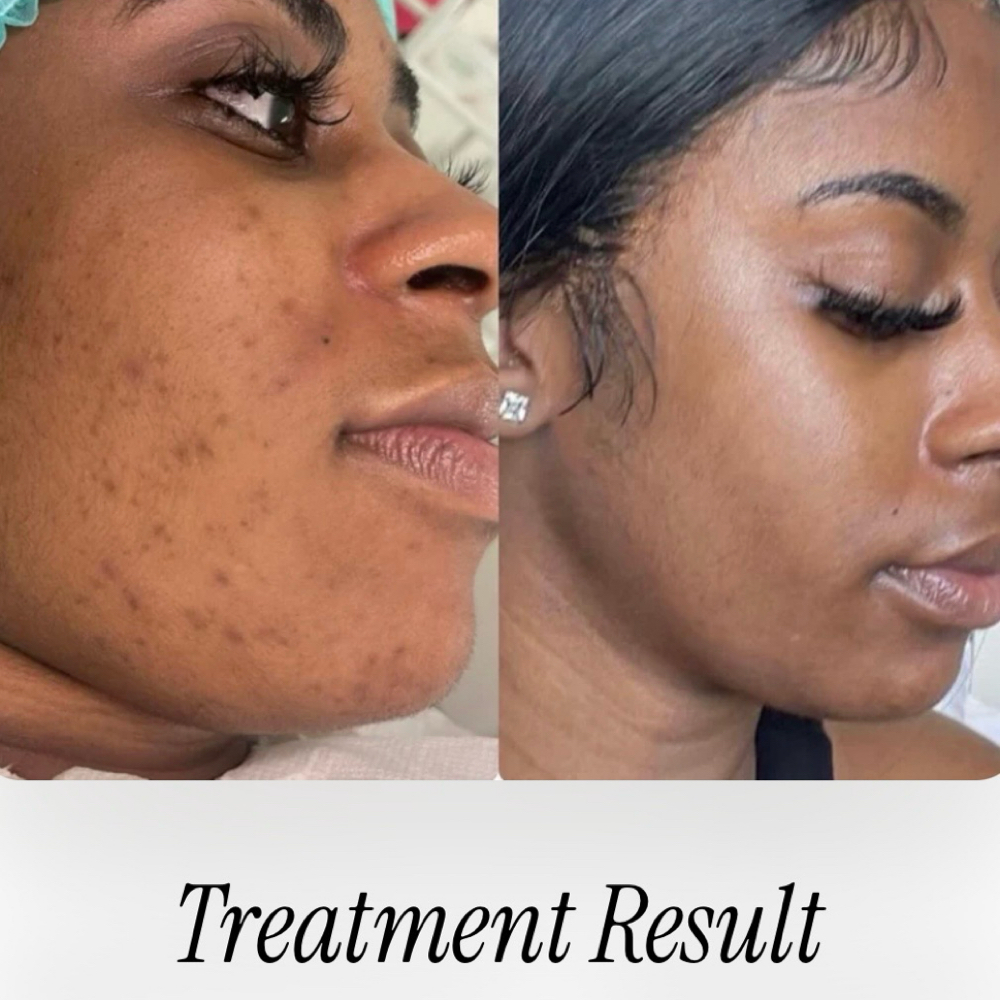 TCA PEEL at All Set Wax Spa in Miami Gardens, FL