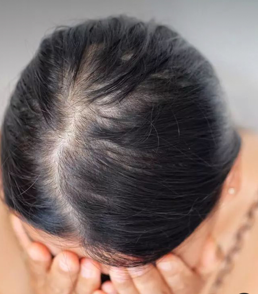 Thinning Hair Treatment