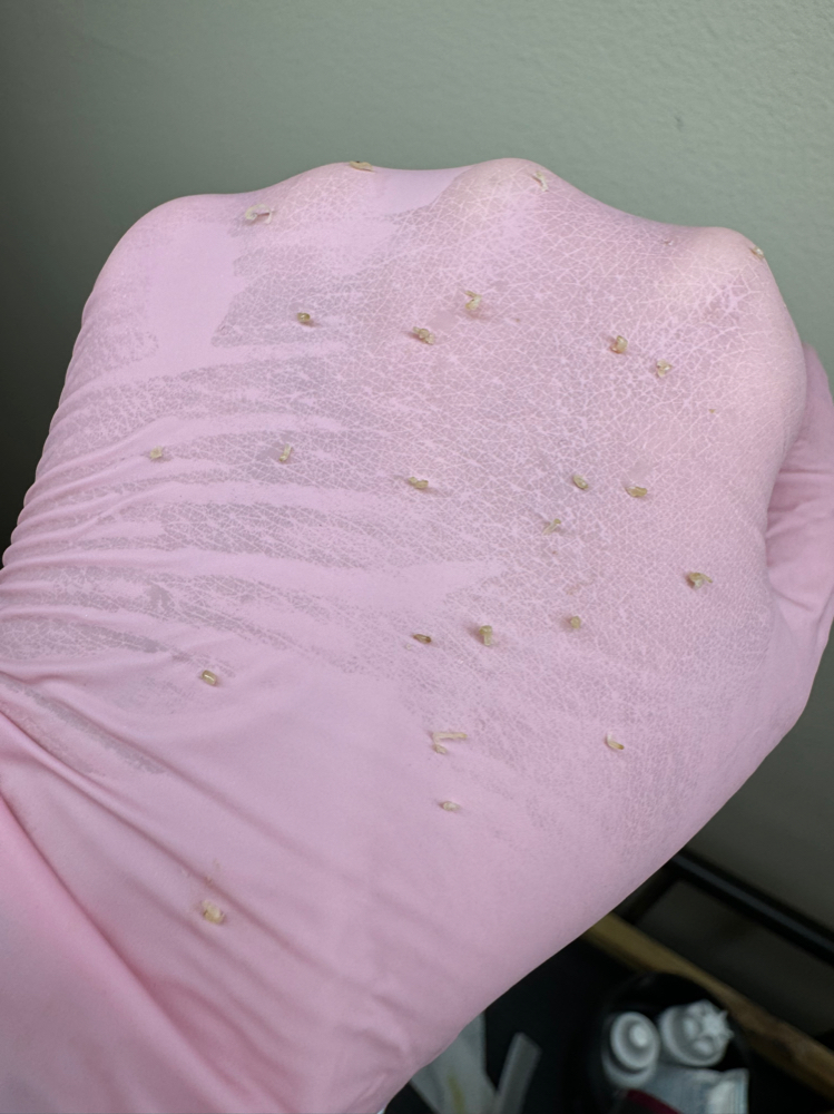 Acne Facial